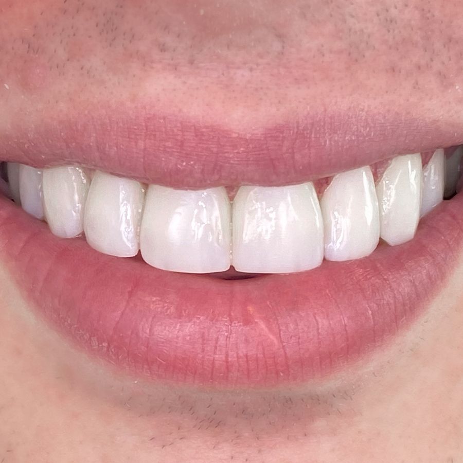 composite bonding - smile 5 - after - 3dental